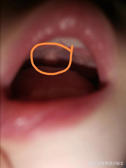 宝宝口腔小肉疙瘩是啥？要紧吗？