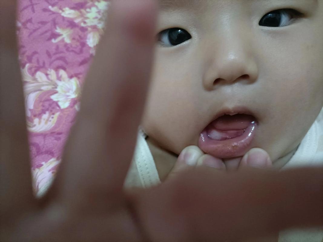 宝宝口腔白点是什么？图片显示正常吗？