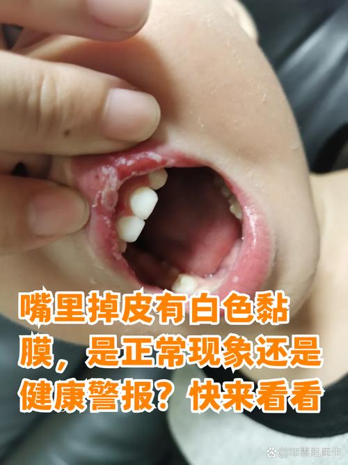 早起口腔白色粘膜是何原因?