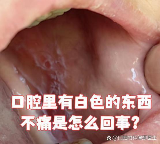 早起口腔白色粘膜是何原因?