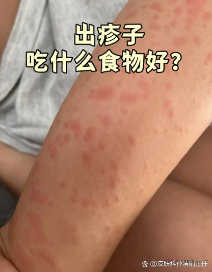牛肉过敏怎么办?能吃吗?