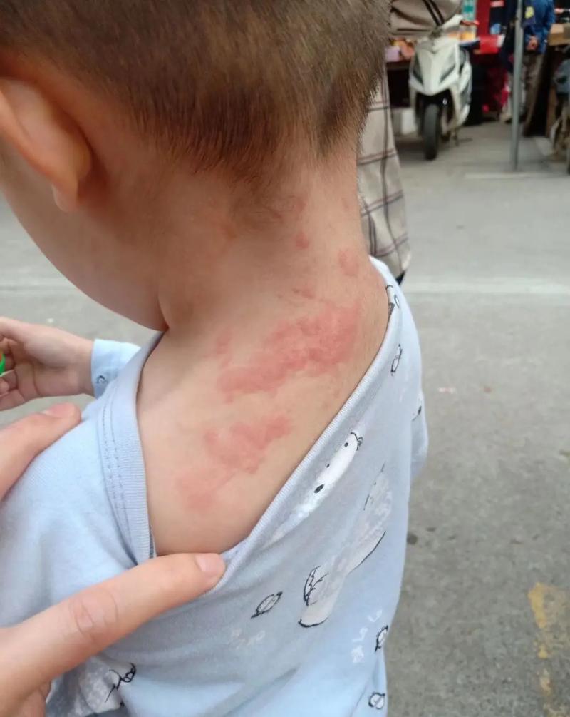 牛肉过敏怎么办?能吃吗?