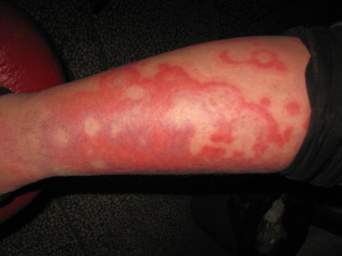 红色一圈是哪种皮肤病？