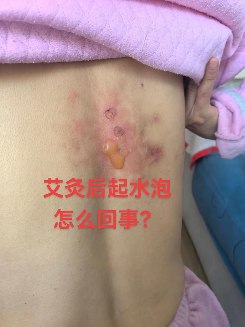 艾灸皮肤痒是排病还是过敏?