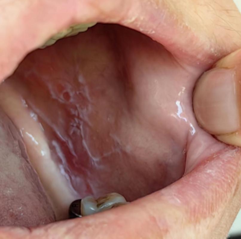 口腔白色黏膜是何原因？