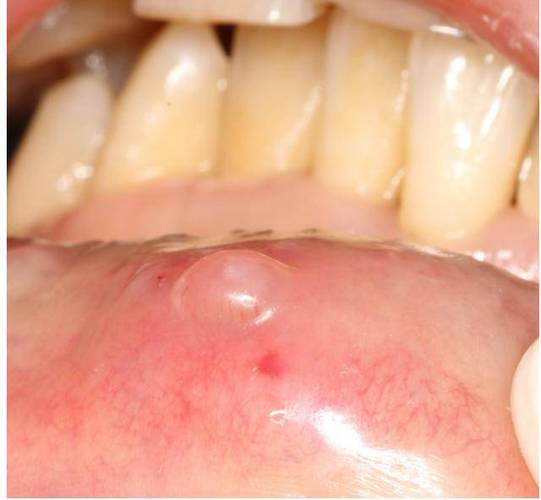 口腔上颚长小泡泡是啥原因？