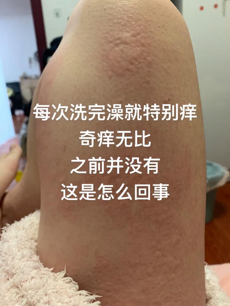皮肤见风就痒是过敏还是缺什么?