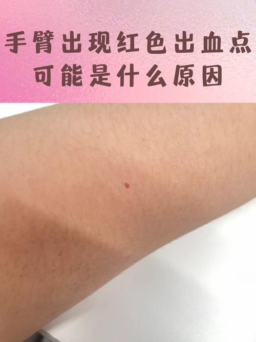 皮肤起小血点是什么原因导致的?