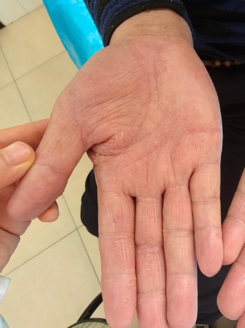 针灸后皮肤痒是何原因所致?