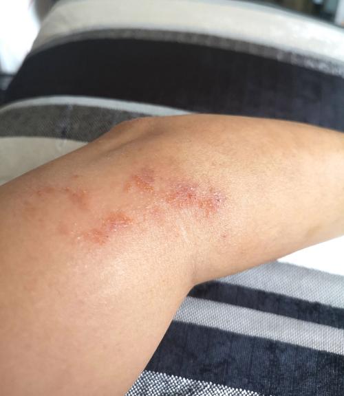 针灸后皮肤痒是何原因所致？