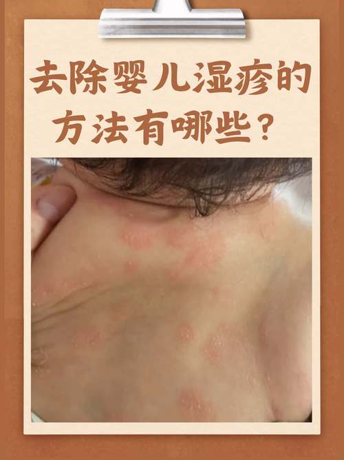 新生儿皮肤湿疹怎么护理才有效？