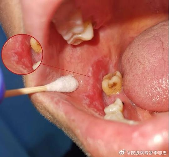 口腔过酸会有哪些症状？