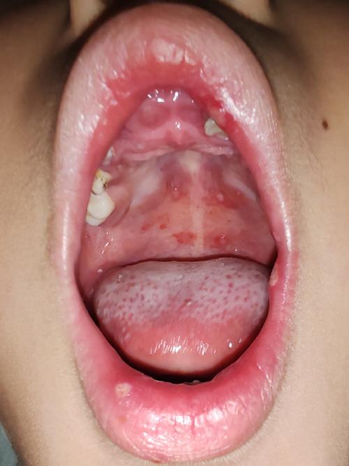 小孩口腔长白泡还发烧是啥病?