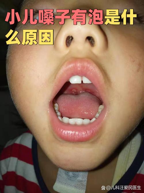 小孩口腔长白泡还发烧是啥病？
