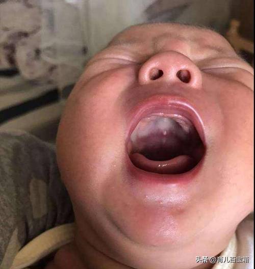 小孩口腔长白泡还发烧是啥病?