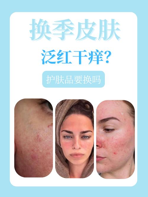 皮肤过敏能用甘油吗?