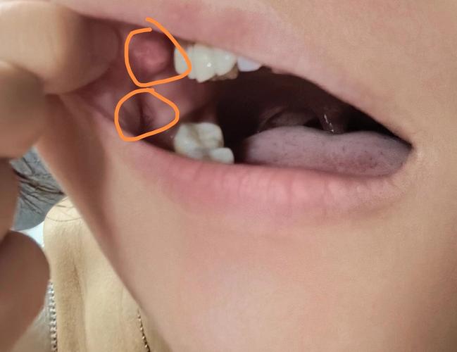 口腔长肉疙瘩是啥病？看图辨原因。