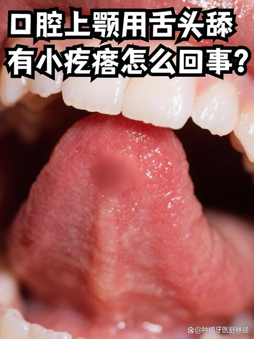 口腔内壁舔到凸起是何问题？