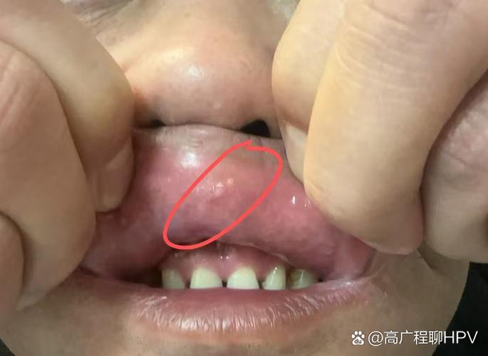 口腔内壁舔到凸起是何问题?