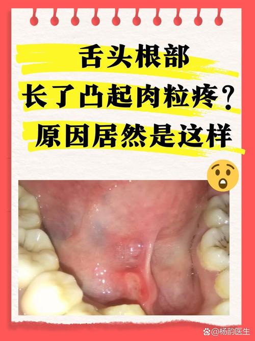 口腔内壁舔到凸起是何问题?