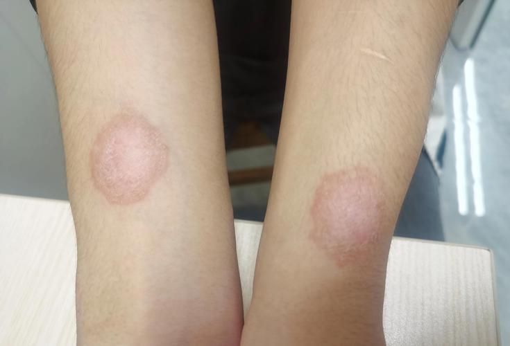 对称性皮肤病有哪些？