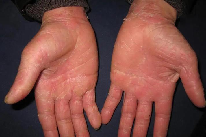 对称性皮肤病有哪些?