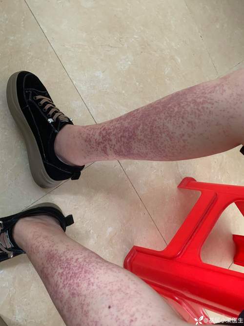 对称性皮肤病有哪些?