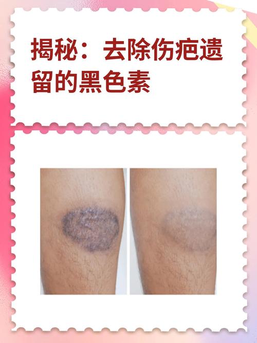 皮肤受伤后变黑,怎么快速恢复原色?