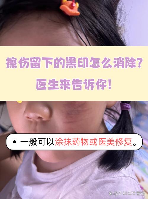 皮肤受伤后变黑，怎么快速恢复原色？