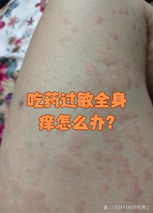 农药过敏皮肤痒,快速止痒方法有哪些?