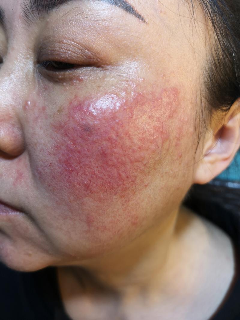 亚硝酸盐中毒后皮肤为何会发绀?