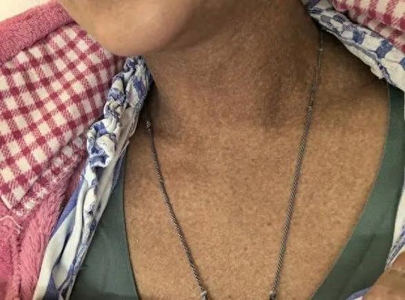 亚硝酸盐中毒后皮肤为何会发绀？