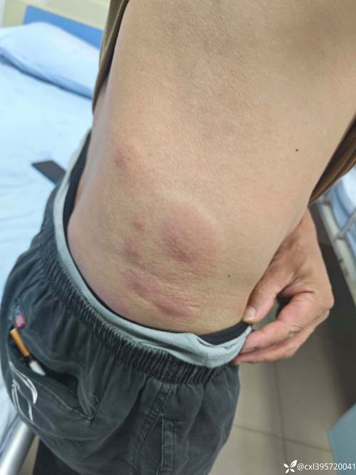 亚硝酸盐中毒后皮肤为何会发绀?