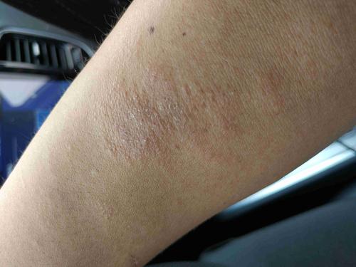 皮肤上起小疙瘩是过敏还是其他问题?