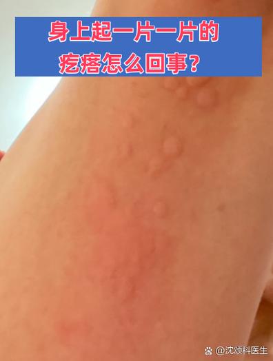 皮肤上起小疙瘩是过敏还是其他问题？