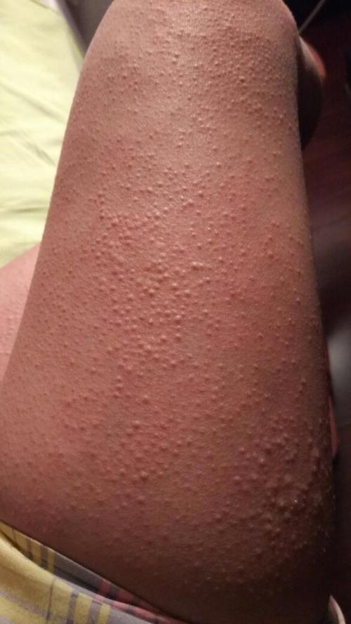 皮肤上起小疙瘩是过敏还是其他问题?