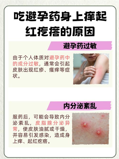 避孕药真能改善皮肤吗?