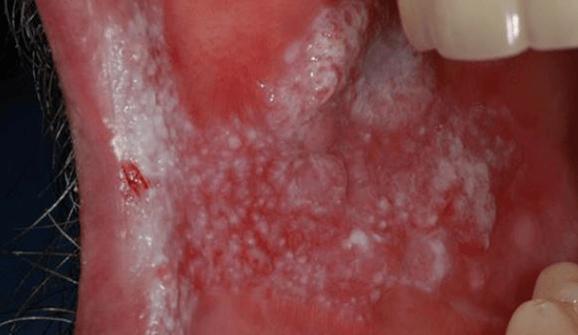 口腔内壁白斑不用怕?到底该咋办?