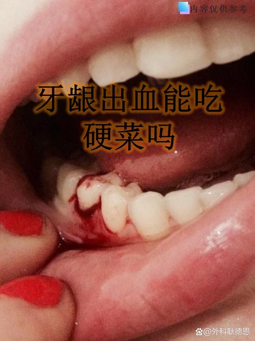 牙龈出血吃什么能快速止血？