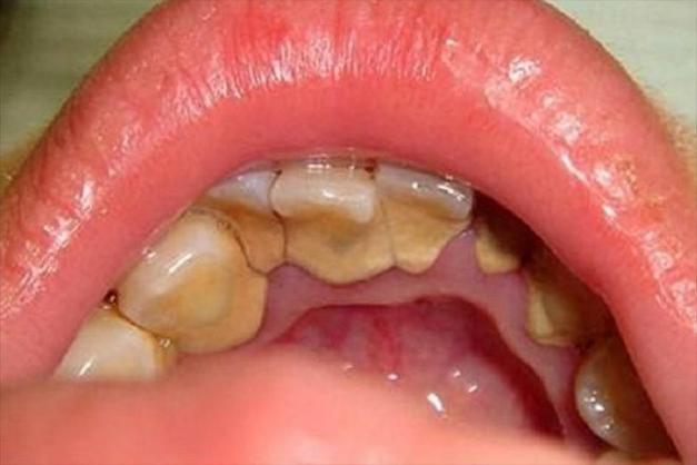 口腔黄颗粒是何物？