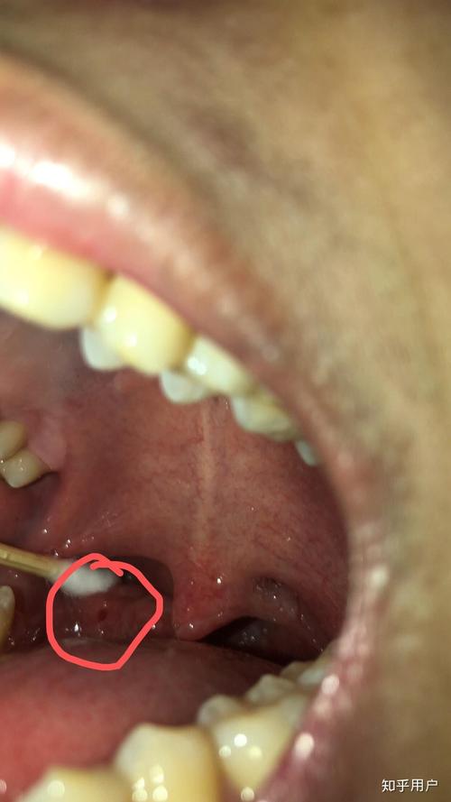 口腔黄颗粒是何物?