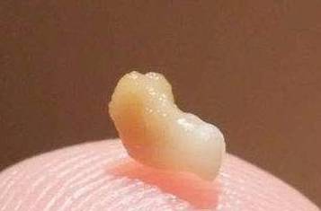 口腔黄颗粒是何物?