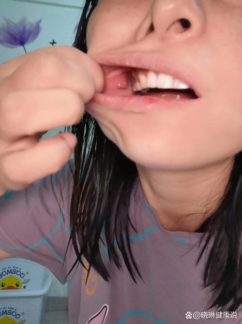 口腔左侧内壁肉疙瘩是何问题?