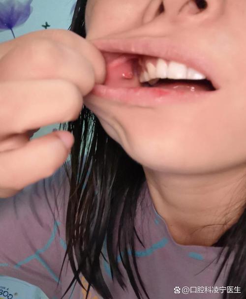 口腔囊肿究竟是如何引起的？