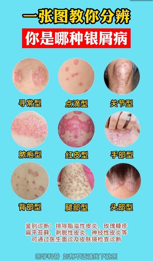 皮肤癣常见类型有哪些？