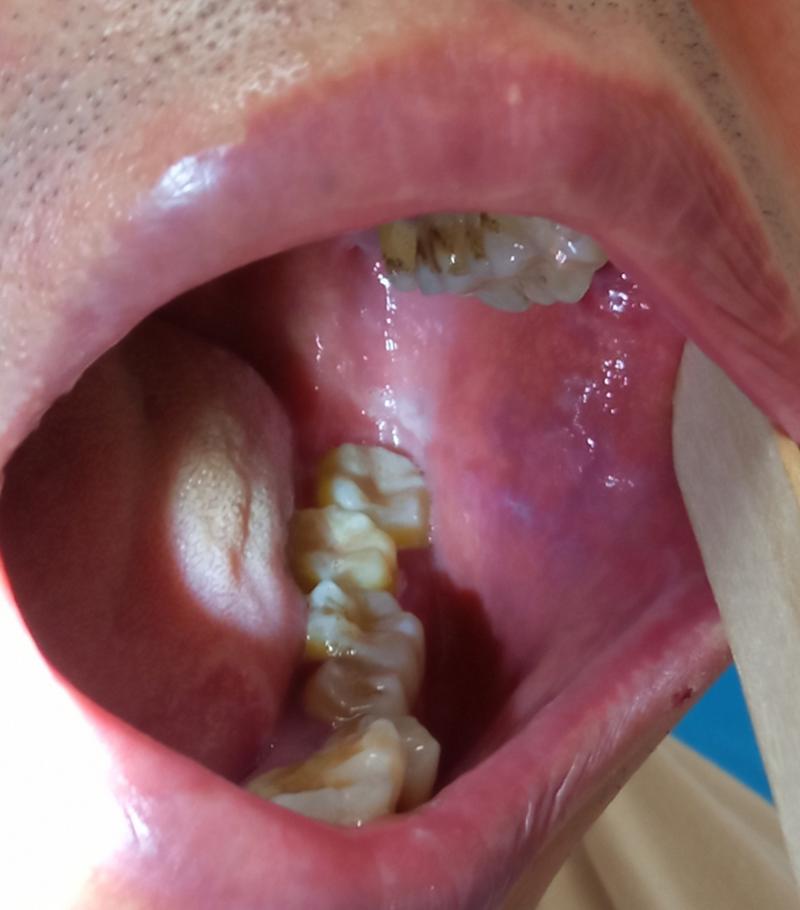 口腔壁白色黏膜图片是何问题？