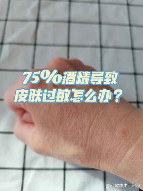 皮肤过敏能用酒精擦吗？