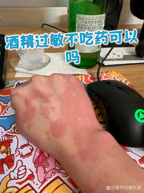 皮肤过敏能用酒精擦吗?