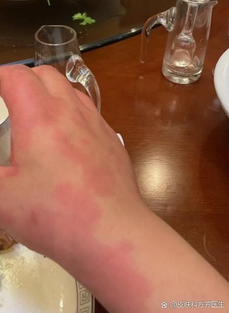 皮肤过敏能用酒精擦吗?