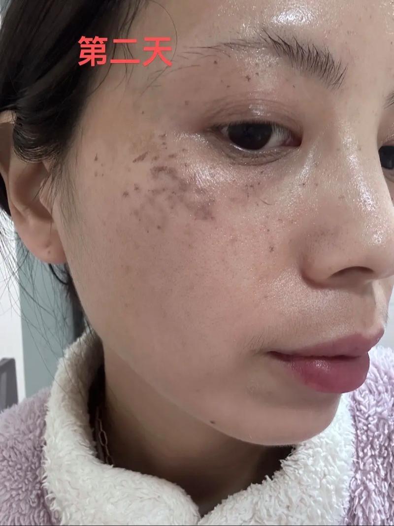 激光祛斑真的会伤害皮肤吗?